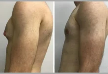 Gynecomastia in Dubai