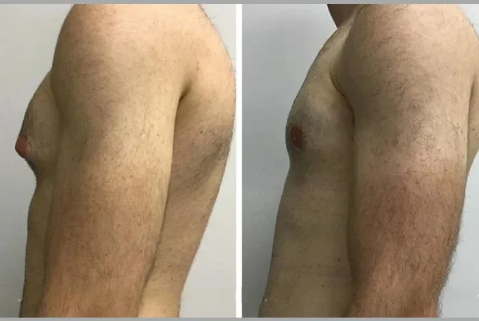 Gynecomastia in Dubai